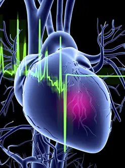 Heart attack and ECG trace Heart attack and ECG trace