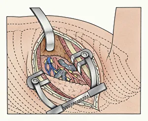 Illustration of abdominal incision between ribs kept open by spreaders exposing human lung and blood vessels Illustration of abdominal incision between ribs kept open by spreaders exposing human lung and blood vessels