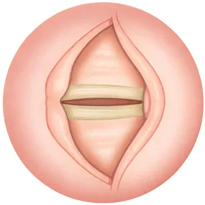 Illustration of closed human vocal fold also known as vocal cord Illustration of closed human vocal fold also known as vocal cord