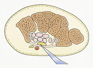 Illustration showing cross section of severed median nerve in wrist caused by sharp piece Illustration showing cross section of severed median nerve in wrist caused by sharp piece