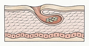 Illustration of subcutaneous scabies eggs Illustration of subcutaneous scabies eggs