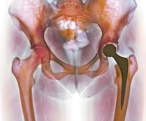 Coloured X-ray Print of Loosened Hip Replacement