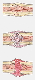 Sequence of illustrations showing complete bone fracture and healing process Sequence of illustrations showing complete bone fracture and healing process