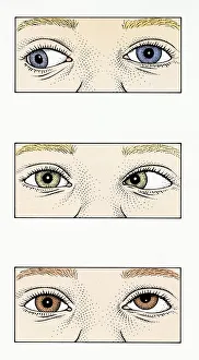 Sequence of illustrations showing Strabismus, Amblyopia, and Duane syndrome in children Sequence of illustrations showing Strabismus, Amblyopia, and Duane syndrome in children