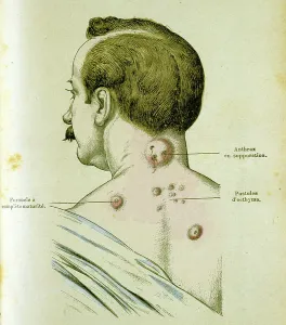 Anthrax Pustules Development Print, 19th Century Engraving