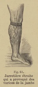 Tight garter causing varicose veins in the leg (engraving) Tight garter causing varicose veins in the leg (engraving)