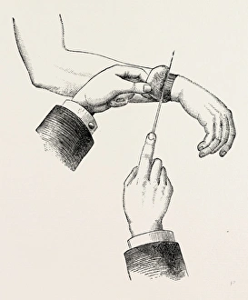 circular amputation de la manchette, medical equipment, surgical instrument, history circular amputation de la manchette, medical equipment, surgical instrument, history
