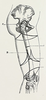 circular amputation of thigh, medical equipment, surgical instrument, history of medicine circular amputation of thigh, medical equipment, surgical instrument, history of medicine