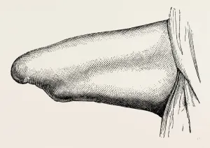 conical stump following circular, medical equipment, surgical instrument, history conical stump following circular, medical equipment, surgical instrument, history