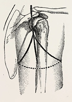 disaetictjlation at the posterior part of the oval, medical equipment, surgical instrument disaetictjlation at the posterior part of the oval, medical equipment, surgical instrument