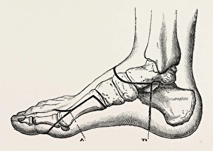 disarticulation of the great toe, medical equipment, surgical instrument, history disarticulation of the great toe, medical equipment, surgical instrument, history