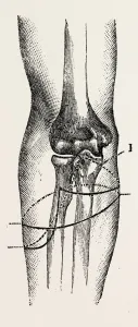 disarticulation, medical equipment, surgical instrument, history of medicine disarticulation, medical equipment, surgical instrument, history of medicine