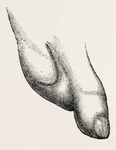 disarticulation the operator, medical equipment, surgical instrument, history of medicine disarticulation the operator, medical equipment, surgical instrument, history of medicine