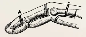 disarticulations, medical equipment, surgical instrument, history of medicine disarticulations, medical equipment, surgical instrument, history of medicine