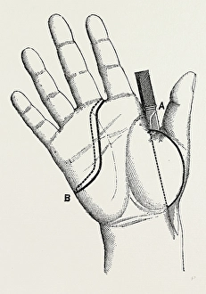disartieulation of the thumb, medical equipment, surgical instrument, history of medicine disartieulation of the thumb, medical equipment, surgical instrument, history of medicine