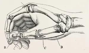 excision of metacarpo-phalangeal joint, medical equipment, surgical instrument, history excision of metacarpo-phalangeal joint, medical equipment, surgical instrument, history
