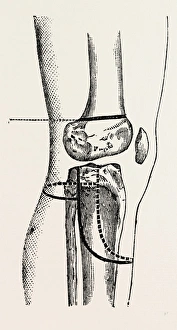 farabeufs amputation, medical equipment, surgical instrument, history of medicine farabeufs amputation, medical equipment, surgical instrument, history of medicine