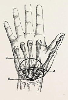the first incision, palmar incision in the circular, medical equipment, surgical the first incision, palmar incision in the circular, medical equipment, surgical