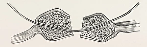 the fragments cut square and the wire in position, medical equipment, surgical instrument the fragments cut square and the wire in position, medical equipment, surgical instrument