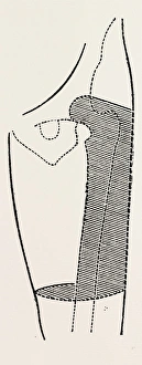 furneaux, medical equipment, surgical instrument, history of medicine furneaux, medical equipment, surgical instrument, history of medicine