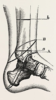 guyons, medical equipment, surgical instrument, history of medicine guyons, medical equipment, surgical instrument, history of medicine