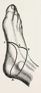 inner and outer sides of the right foot, to show the incisions, medical equipment inner and outer sides of the right foot, to show the incisions, medical equipment