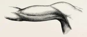 ligature of the brachial about the middle of the arm, medical equipment, surgical ligature of the brachial about the middle of the arm, medical equipment, surgical