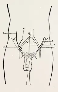 ligature of external iliac, medical equipment, surgical instrument, history of medicine ligature of external iliac, medical equipment, surgical instrument, history of medicine