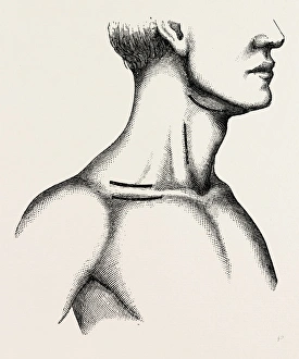 ligature of the first part, medical equipment, surgical instrument, history of medicine ligature of the first part, medical equipment, surgical instrument, history of medicine