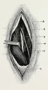 ligature of, femoral are the long saphenous nerve, medical equipment, surgical instrument ligature of, femoral are the long saphenous nerve, medical equipment, surgical instrument