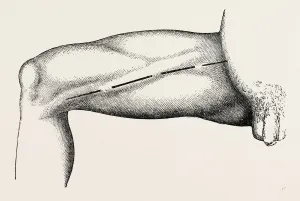 ligature of the right common femoral at the base of scarpas, medical equipment ligature of the right common femoral at the base of scarpas, medical equipment