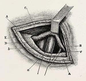 ligature of right external iliac artery, medical equipment, surgical instrument ligature of right external iliac artery, medical equipment, surgical instrument