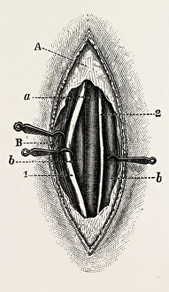 ligature of the right finger, medical equipment, surgical instrument, history of medicine ligature of the right finger, medical equipment, surgical instrument, history of medicine