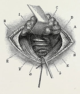 ligature of right lingual artery, medical equipment, surgical instrument, history ligature of right lingual artery, medical equipment, surgical instrument, history