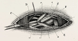 ligature of the right subclavian ernird part, medical equipment, surgical instrument ligature of the right subclavian ernird part, medical equipment, surgical instrument