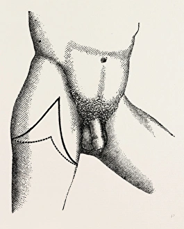 lisfrancs disarticulation, medical equipment, surgical instrument, history of medicine lisfrancs disarticulation, medical equipment, surgical instrument, history of medicine