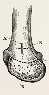 macewen, medical equipment, surgical instrument, history of medicine macewen, medical equipment, surgical instrument, history of medicine