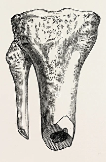 method of method of sawing, medical equipment, surgical instrument, history of medicine method of method of sawing, medical equipment, surgical instrument, history of medicine