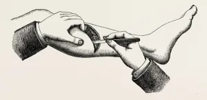 mode of cutting the flap in the amputation at 44, medical equipment, surgical instrument mode of cutting the flap in the amputation at 44, medical equipment, surgical instrument