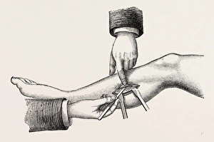 the mode of dividing the solidus muscle in ligature, medical equipment, surgical the mode of dividing the solidus muscle in ligature, medical equipment, surgical
