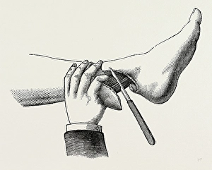 mode of dividing the tissues in the amputation, medical equipment, surgical instrument mode of dividing the tissues in the amputation, medical equipment, surgical instrument