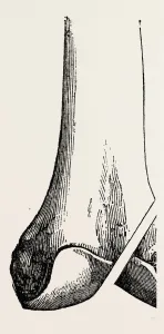 ogstons operation, medical equipment, surgical instrument, history of medicine ogstons operation, medical equipment, surgical instrument, history of medicine