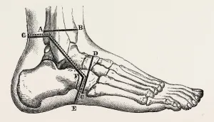 osteo-plastic resection of the foot, medical equipment, surgical instrument, history osteo-plastic resection of the foot, medical equipment, surgical instrument, history