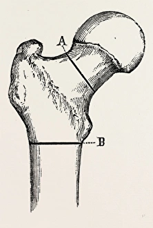 osteotomy, medical equipment, surgical instrument, history of medicine osteotomy, medical equipment, surgical instrument, history of medicine