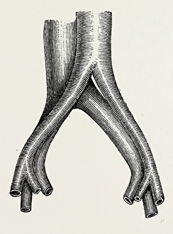relation of veins, medical equipment, surgical instrument, history of medicine relation of veins, medical equipment, surgical instrument, history of medicine