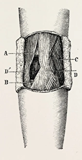 right elbow after excision, medical equipment, surgical instrument, history of medicine right elbow after excision, medical equipment, surgical instrument, history of medicine