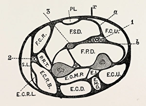 section of the forearm, medical equipment, surgical instrument, history of medicine section of the forearm, medical equipment, surgical instrument, history of medicine