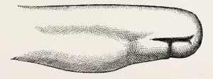 stump left after, medical equipment, surgical instrument, history of medicine stump left after, medical equipment, surgical instrument, history of medicine