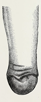 stump, medical equipment, surgical instrument, history of medicine stump, medical equipment, surgical instrument, history of medicine