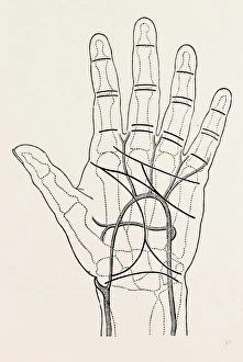 surface markings on the palm of ffile hand, the thick black lines represent the chief surface markings on the palm of ffile hand, the thick black lines represent the chief